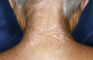 Read more about the article Σκληρόδερμα – Ανδρέας