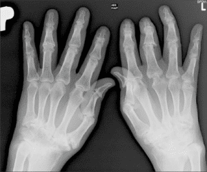 Read more about the article Ψωριασική αρθρίτιδα , Σύνδρομο Πολυκυστικών Ωοθηκών – Αναστασία