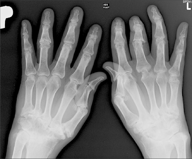 Read more about the article Ψωριασική αρθρίτιδα , Σύνδρομο Πολυκυστικών Ωοθηκών – Αναστασία